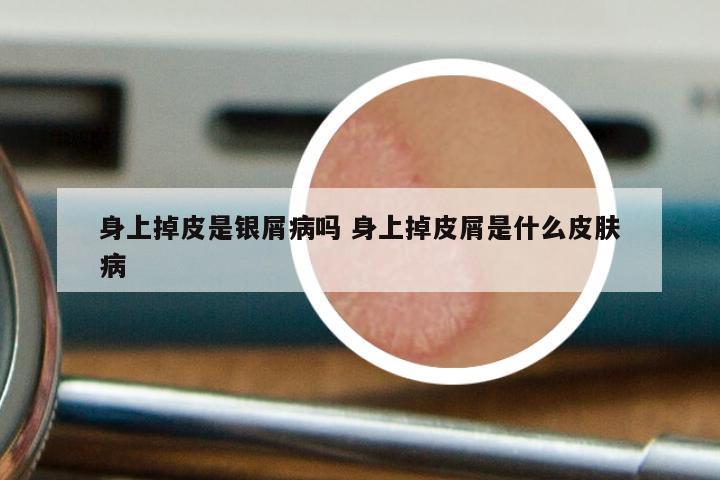 身上掉皮是银屑病吗 身上掉皮屑是什么皮肤病