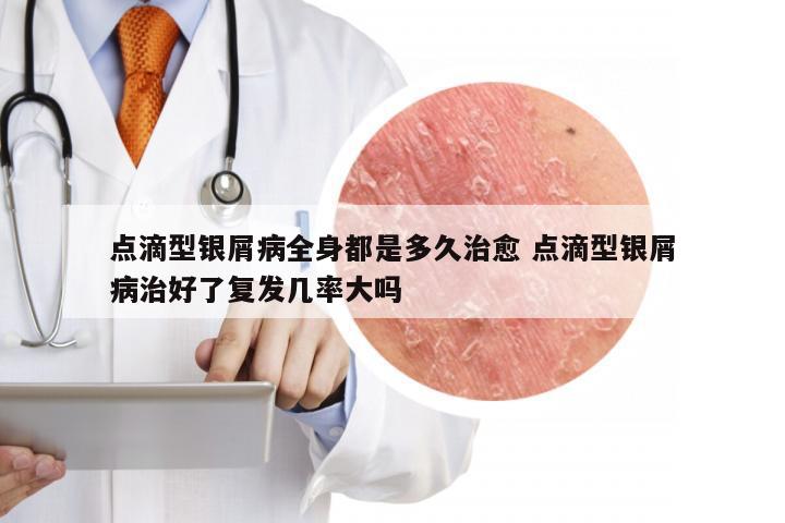 点滴型银屑病全身都是多久治愈 点滴型银屑病治好了复发几率大吗