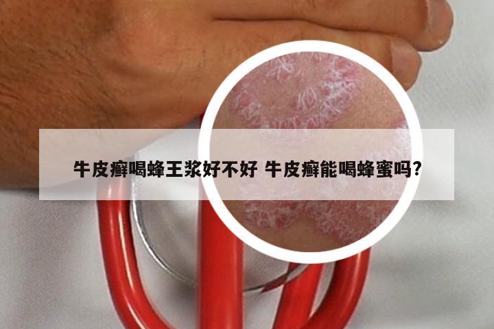 牛皮癣喝蜂王浆好不好 牛皮癣能喝蜂蜜吗?