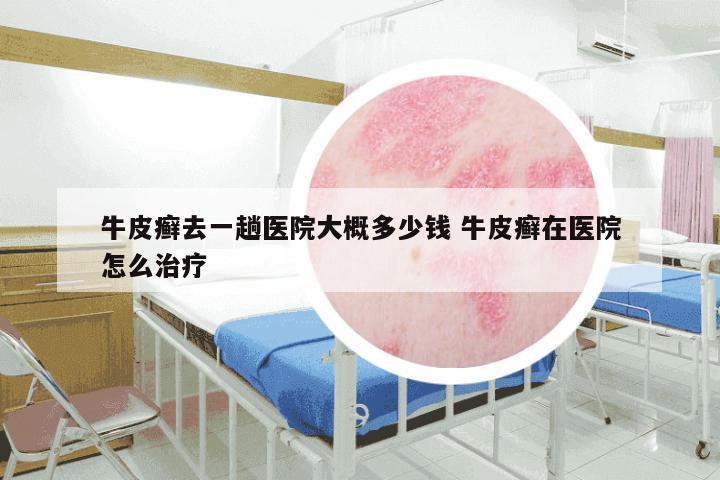 牛皮癣去一趟医院大概多少钱 牛皮癣在医院怎么治疗