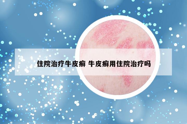 住院治疗牛皮癣 牛皮癣用住院治疗吗