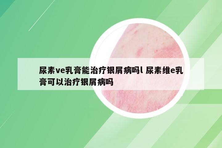 尿素ve乳膏能治疗银屑病吗l 尿素维e乳膏可以治疗银屑病吗