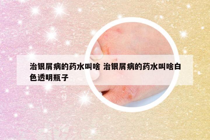 治银屑病的药水叫啥 治银屑病的药水叫啥白色透明瓶子