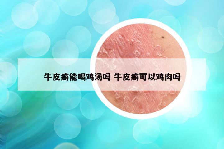 牛皮癣能喝鸡汤吗 牛皮癣可以鸡肉吗