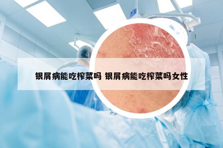 银屑病能吃榨菜吗 银屑病能吃榨菜吗女性