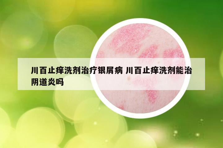 川百止痒洗剂治疗银屑病 川百止痒洗剂能治阴道炎吗
