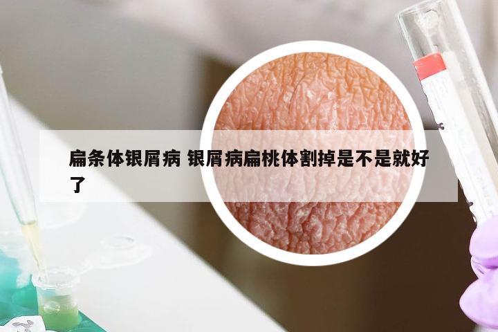 扁条体银屑病 银屑病扁桃体割掉是不是就好了