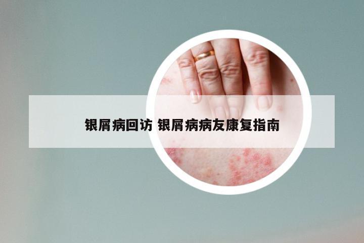 银屑病回访 银屑病病友康复指南