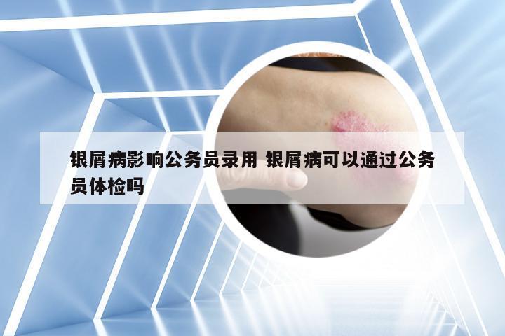 银屑病影响公务员录用 银屑病可以通过公务员体检吗