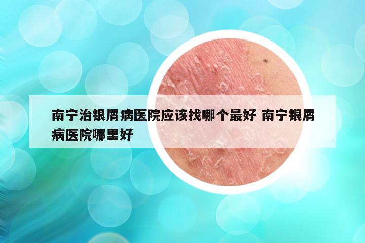 南宁治银屑病医院应该找哪个最好 南宁银屑病医院哪里好