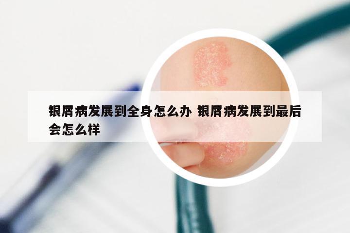 银屑病发展到全身怎么办 银屑病发展到最后会怎么样