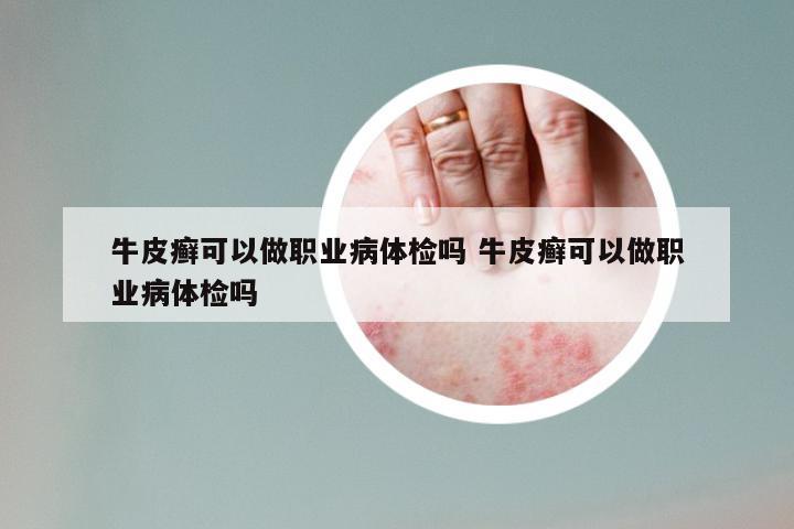 牛皮癣可以做职业病体检吗 牛皮癣可以做职业病体检吗