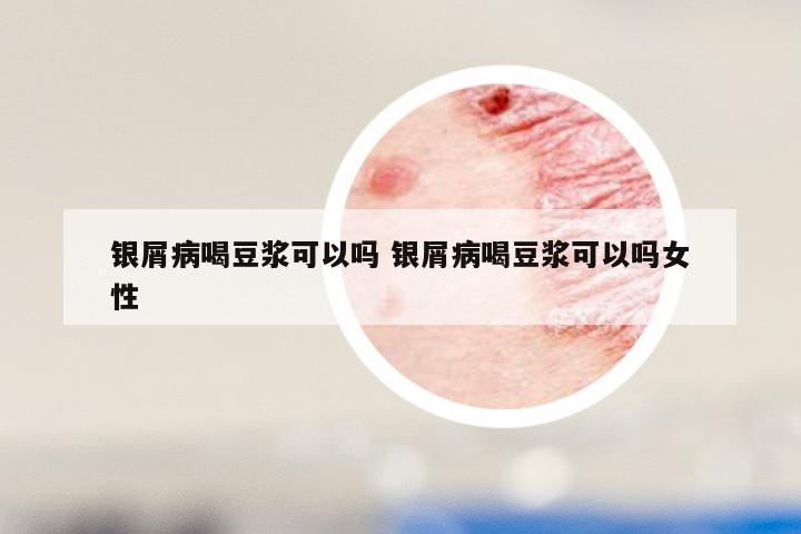 银屑病喝豆浆可以吗 银屑病喝豆浆可以吗女性