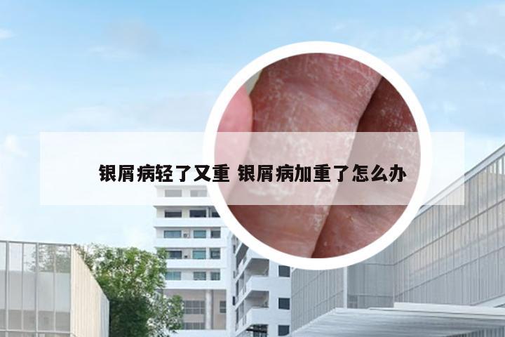 银屑病轻了又重 银屑病加重了怎么办
