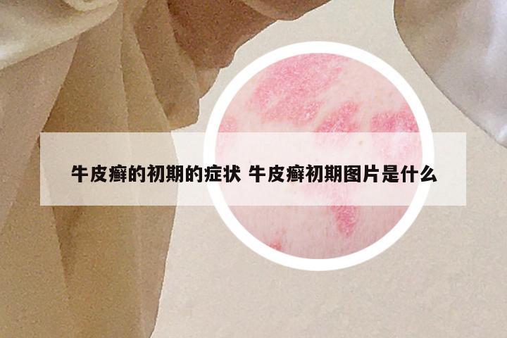 牛皮癣的初期的症状 牛皮癣初期图片是什么