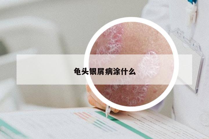 龟头银屑病涂什么