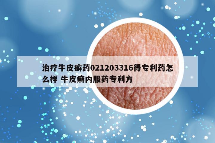 治疗牛皮癣药021203316得专利药怎么样 牛皮癣内服药专利方