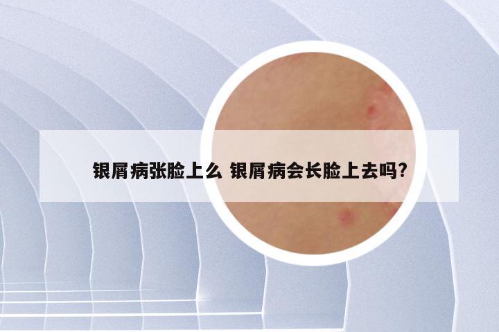 银屑病张脸上么 银屑病会长脸上去吗?