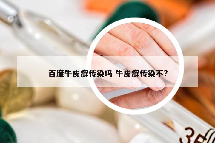 百度牛皮癣传染吗 牛皮癣传染不?