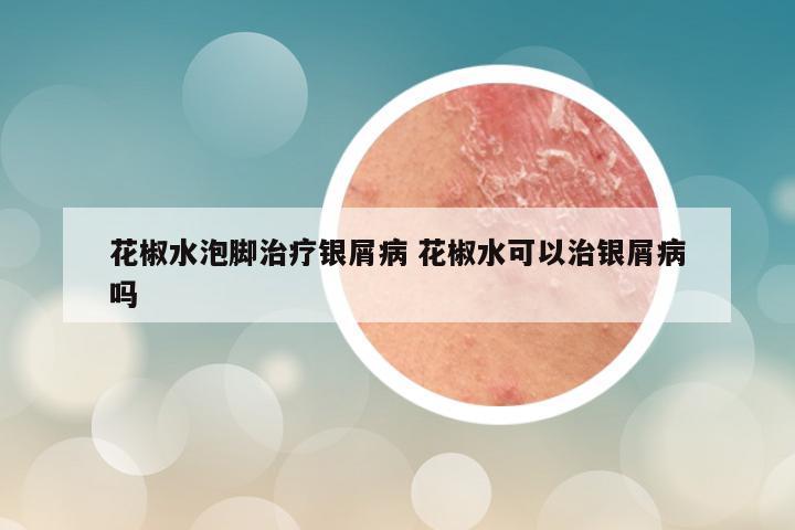 花椒水泡脚治疗银屑病 花椒水可以治银屑病吗