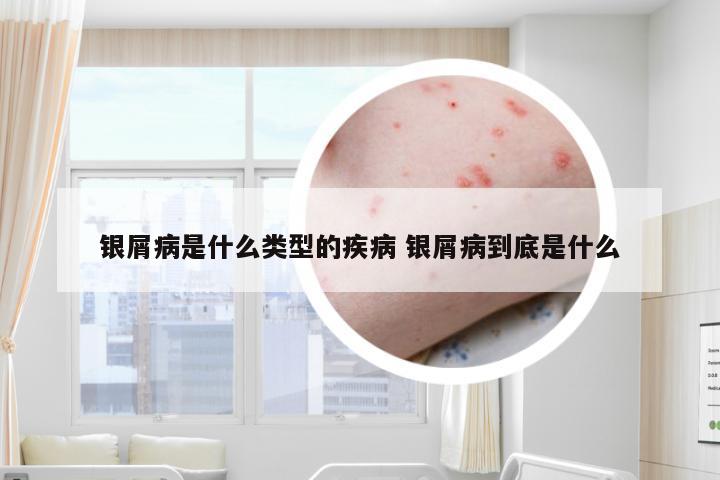 银屑病是什么类型的疾病 银屑病到底是什么