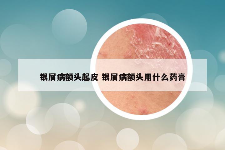 银屑病额头起皮 银屑病额头用什么药膏