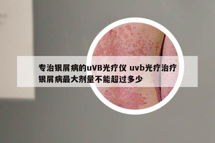 专治银屑病的uVB光疗仪 uvb光疗治疗银屑病最大剂量不能超过多少