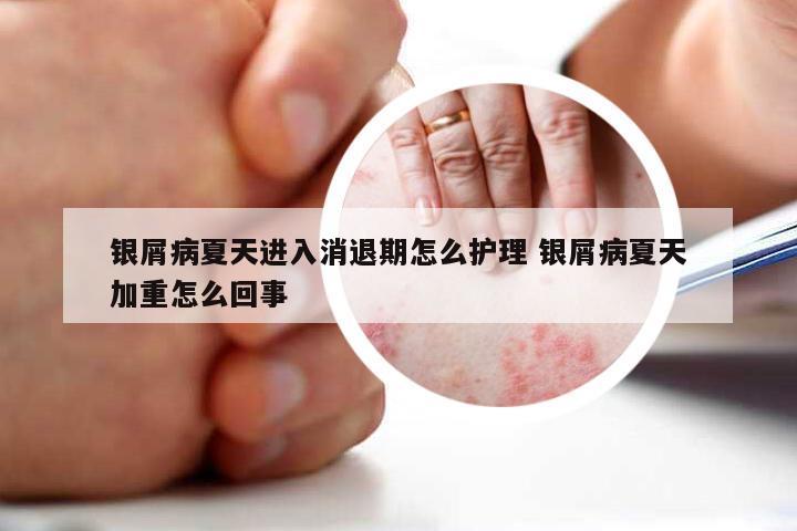 银屑病夏天进入消退期怎么护理 银屑病夏天加重怎么回事