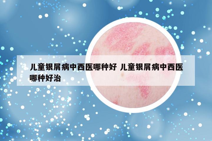 儿童银屑病中西医哪种好 儿童银屑病中西医哪种好治