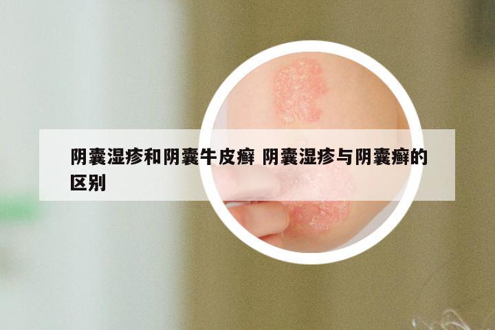 阴囊湿疹和阴囊牛皮癣 阴囊湿疹与阴囊癣的区别