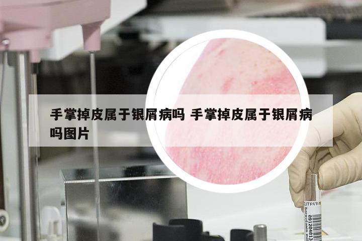 手掌掉皮属于银屑病吗 手掌掉皮属于银屑病吗图片