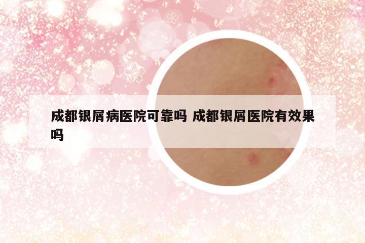 成都银屑病医院可靠吗 成都银屑医院有效果吗