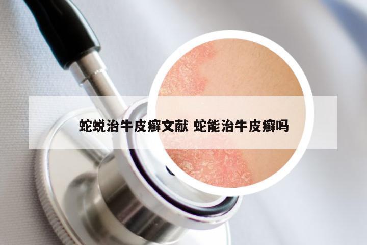 蛇蜕治牛皮癣文献 蛇能治牛皮癣吗