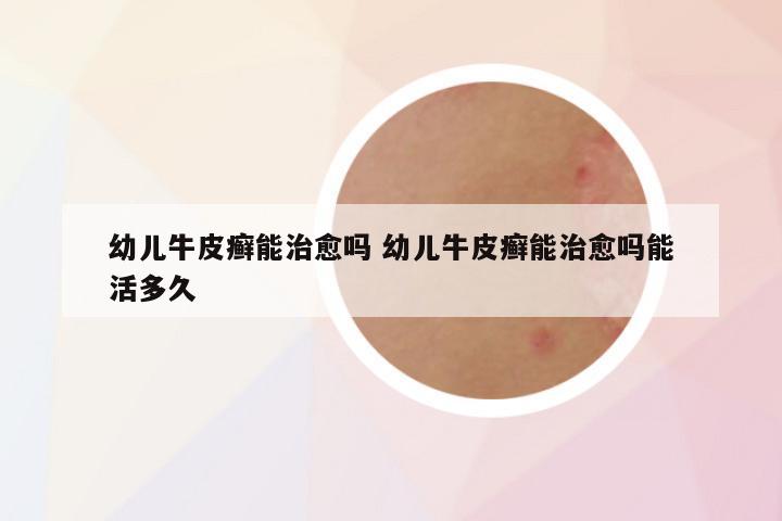 幼儿牛皮癣能治愈吗 幼儿牛皮癣能治愈吗能活多久