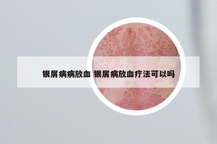 银屑病病放血 银屑病放血疗法可以吗