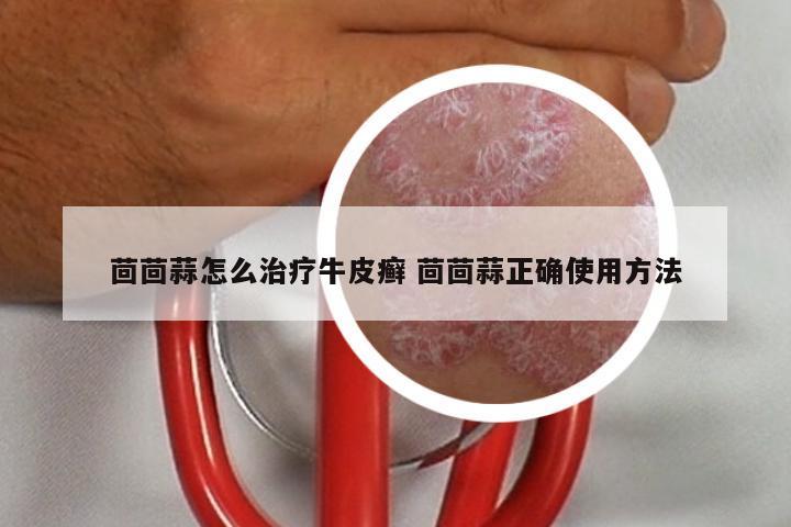 茴茴蒜怎么治疗牛皮癣 茴茴蒜正确使用方法
