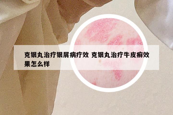 克银丸治疗银屑病疗效 克银丸治疗牛皮癣效果怎么样