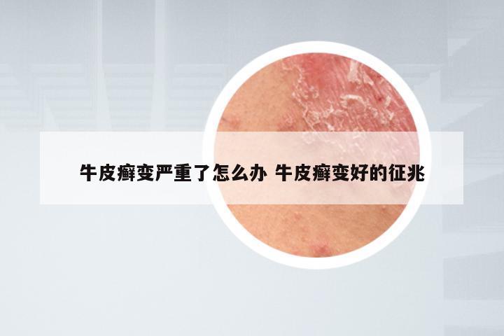 牛皮癣变严重了怎么办 牛皮癣变好的征兆
