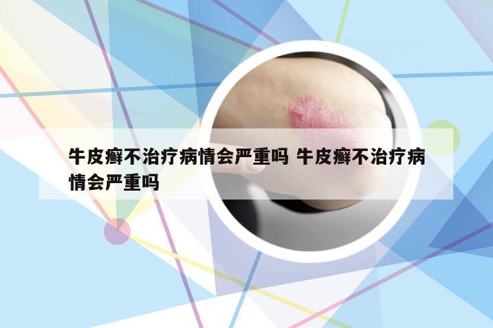 牛皮癣不治疗病情会严重吗 牛皮癣不治疗病情会严重吗