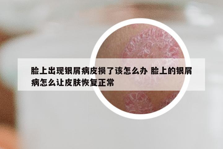 脸上出现银屑病皮损了该怎么办 脸上的银屑病怎么让皮肤恢复正常