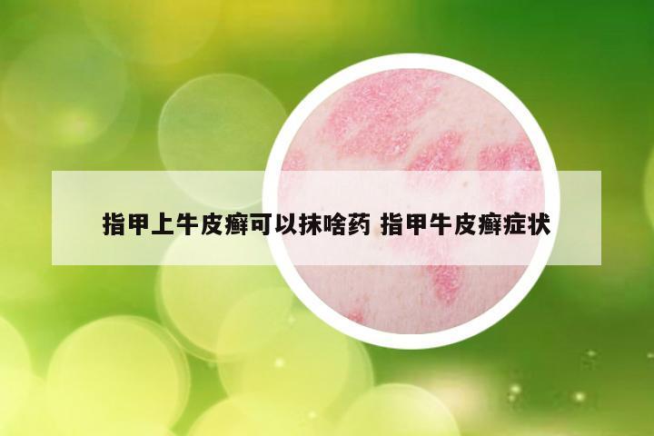 指甲上牛皮癣可以抹啥药 指甲牛皮癣症状