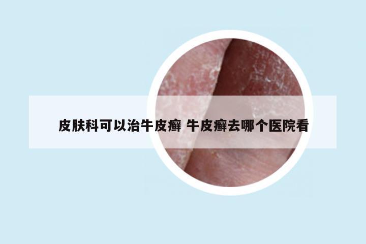 皮肤科可以治牛皮癣 牛皮癣去哪个医院看