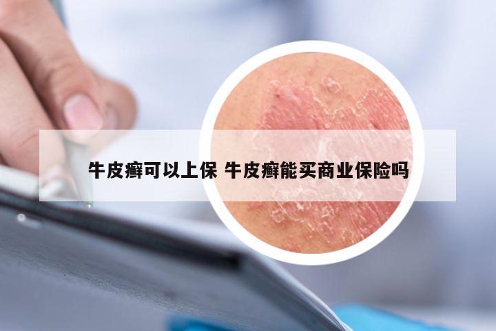 牛皮癣可以上保 牛皮癣能买商业保险吗
