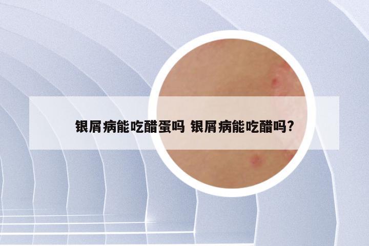 银屑病能吃醋蛋吗 银屑病能吃醋吗?