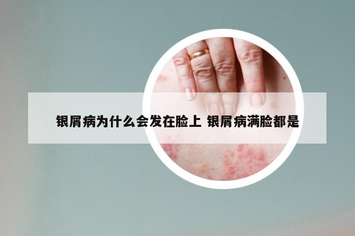 银屑病为什么会发在脸上 银屑病满脸都是