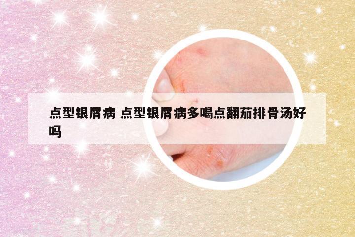 点型银屑病 点型银屑病多喝点翻茄排骨汤好吗