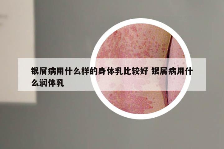 银屑病用什么样的身体乳比较好 银屑病用什么润体乳