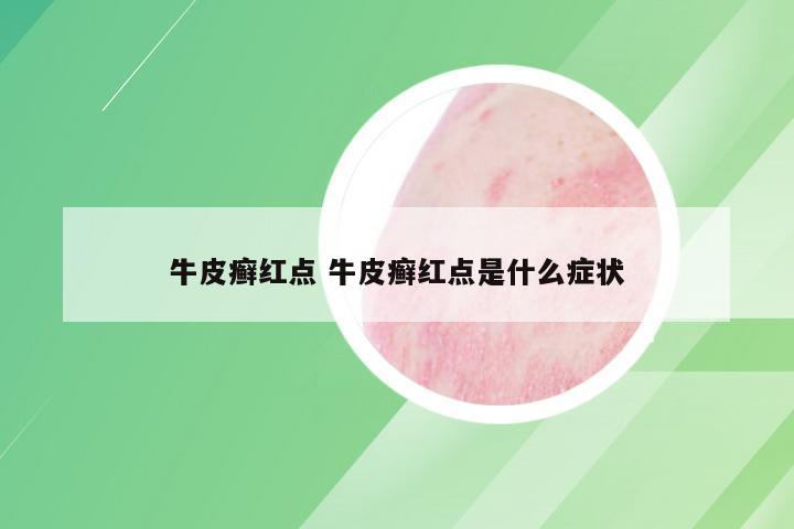 牛皮癣红点 牛皮癣红点是什么症状