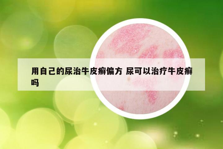 用自己的尿治牛皮癣偏方 尿可以治疗牛皮癣吗