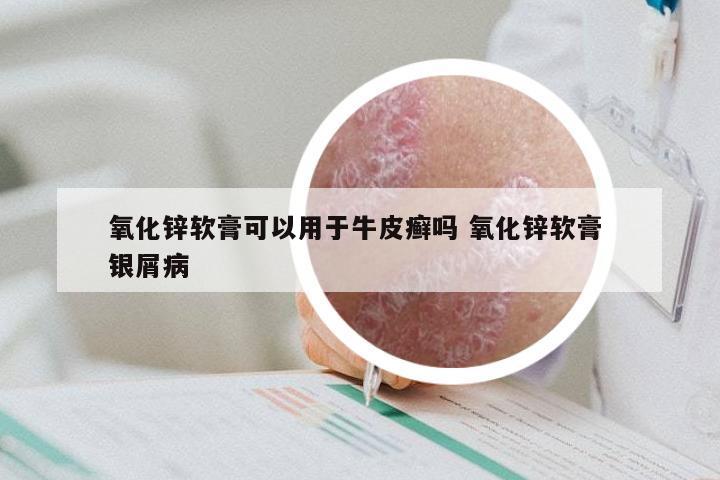 氧化锌软膏可以用于牛皮癣吗 氧化锌软膏 银屑病